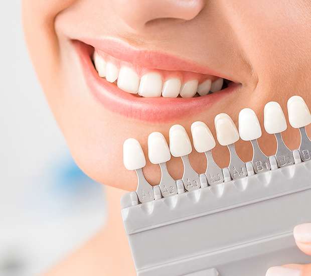 North Little Rock Dental Veneers and Dental Laminates