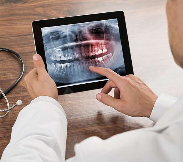 North Little Rock Types of Dental Root Fractures
