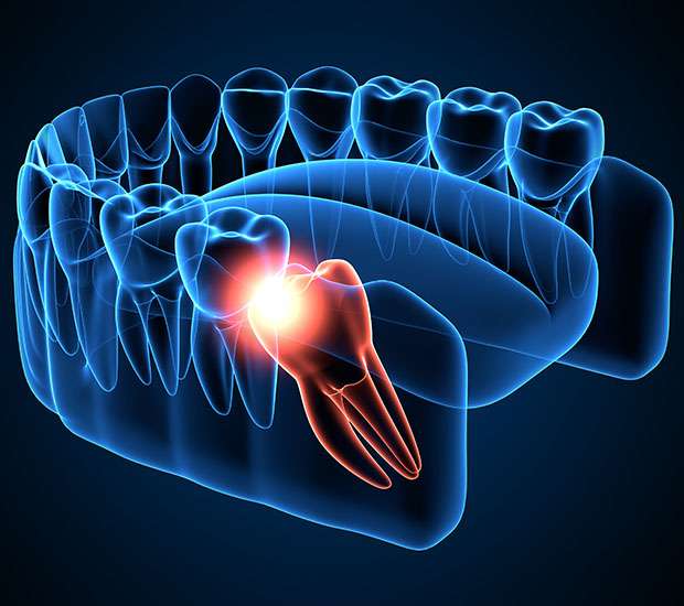 North Little Rock Wisdom Teeth Extraction